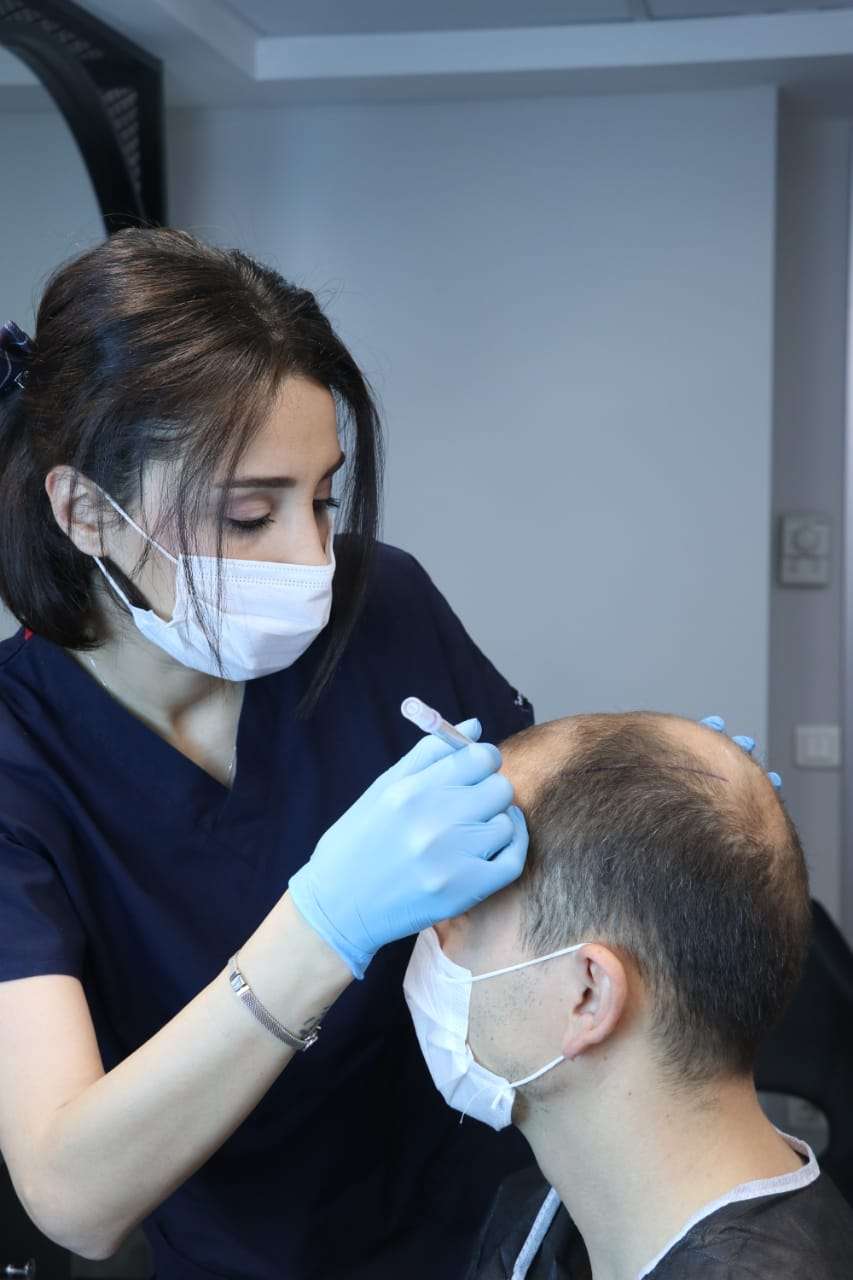 Istanbul, a city that hosts many patients from Europe, Asia, and Africa who has the intention of getting hair transplantation, knows no rivals in this regard. The hair transplant operation has become the number one in Istanbul health tourism in terms of affordable prices, operation volume, and experience. Pure Line Clinic Operations Manager Selim Peltekci says, “The prices are low compared to the average number in the world. Besides, hair transplantation is performed by experts who exceed world standards in the field, and patients are thoroughly informed about the operations. These are the reasons why people prefer us.” Hair transplantation is one of the most popular aesthetic interventions in recent years. In the field of hair transplants, which have been performed in Turkey for more than a decade now, significant progress has been made in recent years. For instance, while Arabs were already interested in getting hair transplant treatment in Istanbul, the interest of Europeans only recently emerged, adding a whole new market to the sector. Currently, demands from UK, France, Spain, and Italy are quite high. Although the advanced treatment methods are being used and the affordable prices make Istanbul a center of attraction for hair transplantation, the most important factor in which all these patients are eyeing Istanbul is the abundance of experts who do their job well. There are some crucial points to be considered before getting hair transplantation. Warning patients against unauthorized clinics, Peltekci said: “Hair transplantation must be done by expert teams in the hospital. The reason why some hair transplant clinics in Turkey offer very, unreasonably low prices is that the operation is performed by inexperienced teams and the materials used are of poor quality.” “Therefore,” Peltekci continued, “patients should be careful in their selection of clinics. Since many diseases can occur on the scalp, not every skin is suitable for a transplant operation. Especially in patients with open wounds on their body, if uncontrolled transplantation is performed, the hair and skin of the patient are likely to be severely damaged and cause a serious health problem.” Even though Istanbul provides a lot of high-quality options, including Pure Line Clinic, for international patients as far as hair transplantation is concerned, the metropole is also filled with amateurs as well as opportunists who take advantage of the flow of health tourists to the city. Unfortunately, currently, there are a lot of clinics that prefer quantity over quality. This situation leads them to act as a factory where patients do not receive the treatment they deserve and thus, often end up in disappointment. Thus, the patients must look for clinics where patient’s comfort is prioritized over everything. In other words, clinics with fewer patients but more hospitality must be the way to go as far as hair transplant treatment is concerned. Who are the right candidates for hair transplantation operation? People who demand to get hair transplantation can be roughly separated into four groups. The biggest group consists of people who are suffering from the male pattern baldness problem. These baldness cases are usually genetic. That's why the professional clinics, including Pure Line Clinic, don't operate the hair transplant operation right away in these specific cases. First, the expert doctors look at the age of the patient, and the rate and course of the hair loss. Shedding, which generally starts at the age of 23-24, ends at 33-34. In these cases, the doctors first apply medical treatment to patients under the age of 25 and support this treatment with hair mesotherapy. By doing so, the doctors are trying to protect the existing hair. That being said, in some special cases, hair transplants can be performed on individuals under the age of 25 as well. Women are also constituting a large group when it comes to demanding to get a hair transplantation operation. However, the examination process, the way it is done, the drawing, and the shaving are all different processes between men and women. Generally, there is a circular opening at the central point of women’s heads, which usually emerges as they get older. The most common hair transplant method for women around the world is the DHI technique, which is performed in Pure Line Clinic with utmost perfection. In this method, the doctor needs to determine the area where the opening emerges and work on point shooting. People with dermatological diseases constitute yet another group that applies for hair transplantation. These people may have psoriasis, have had ringworm, or have previously burned and dried hair follicles. In such cases, going to an experienced clinic gains special importance since not every doctor is capable of operating on people with such complicated conditions. Last but certainly not least, some people are seeking revision surgeries. These are patients who had an unsuccessful hair transplant operation before. It is likely for these patients to have a damaged scalp. In such cases, the DHI technique might be the ultimate solution. Which tests are performed on patients before the procedure? First, the doctor examines the blood tests of the incoming patients. By doing so, he/she is trying to understand what are the problems that are causing or accelerating hair loss. Treatment is applied to those who have iron, vitamin deficiencies, and thyroid disorders. After receiving approval from the internal medicine specialist, the doctor moves on to the implanting phase. Scalp examination is also very important at this point. Damaged and unhealthy skin should not be implanted with hair immediately. Instead, the scalp must be treated first. Where are the roots taken from? There are hair follicles resistant to shedding in our nape area. The grafts, a.k.a. the roots, are extracted one by one from the nape region in a way that will fit the area where hair will be implanted. These roots are divided into single, double, and triple grafts. The extracted grafts are then implanted one by one in the bald area. The separated grafts are appropriately transplanted into the area to ensure the natural appearance of the hair. When the grafts are taken by experienced specialists, no sparsity emerges in the donor area. If the nape root reserve is not sufficient, roots can also be taken from the beard area under the chin. How many types of techniques are there? There are 3 types of techniques. Classic FUE, DHI, and FUT. We apply the most effective techniques DHI and classical FUE techniques. In FUE and FUT, implanting is done with the canal method. In the DHI technique, implanting is done one by one. Currently, the most preferred methods in the world are FUE and DHI techniques. In these techniques, individual grafts are collected from the donor area. FUT is a surgical procedure. The roots are cut along with the skin from the nape and implanted where needed. This is mostly used by American doctors. Roots are grasped with forceps and filled into canals. In the DHI technique, the DHI pen has its special tip. We do not open channels. Here we insert the DHI pen into the opening and implant the root according to the angle. How many grafts are being transplanted in one session? The numbers may vary depending on the patient's condition. In general, a maximum of 5000 grafts are transplanted. In fact, up to 7,000 grafts can be taken from the nape, depending on the patient's condition. But here it is important to implant as much as the skin can feed. This is one of the most common mistakes made by amateur doctors. Some clinics plant 6000, and 7000 grafts in one session, which does not make any sense. More than 5000 grafts plantings do not feed the skin of the hair and, unavoidably, the hair begins to die. In a hair transplant operation, long-term planning is a must and each transplant should be structured specifically for an individual case rather than applying the same methods to everyone.  When can the patient return to his/her normal life? Even though it might vary depending on the case, most patients can return to their normal life in an average of 1-2 weeks. Antibiotic treatment is provided for 5 days following the operation. After transferring the grafts to the new area, it takes 3-4 months for the skin of the hair to heal, for the roots to take hold and for the hair to start growing. In this process, vitamin support and the use of the right shampoo are highly important. There is also a one-year follow-up period.