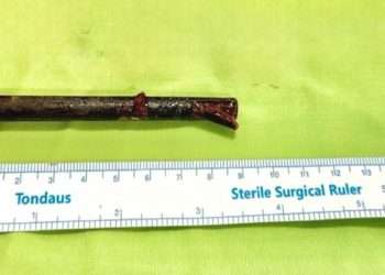 Drunk man gets three inch chopstick stuck behind his eye after ‘colliding’ into friend